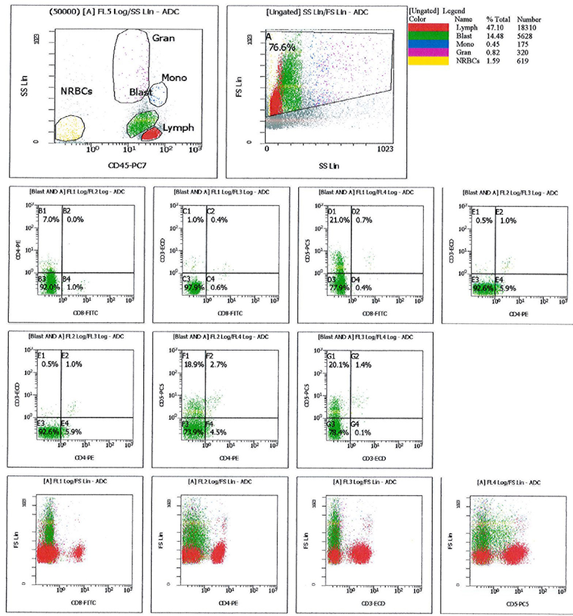 Flow cytometry of the FNA from pelvic lymph node showing that blasts have no expression of lymphoid markers except dim CD5